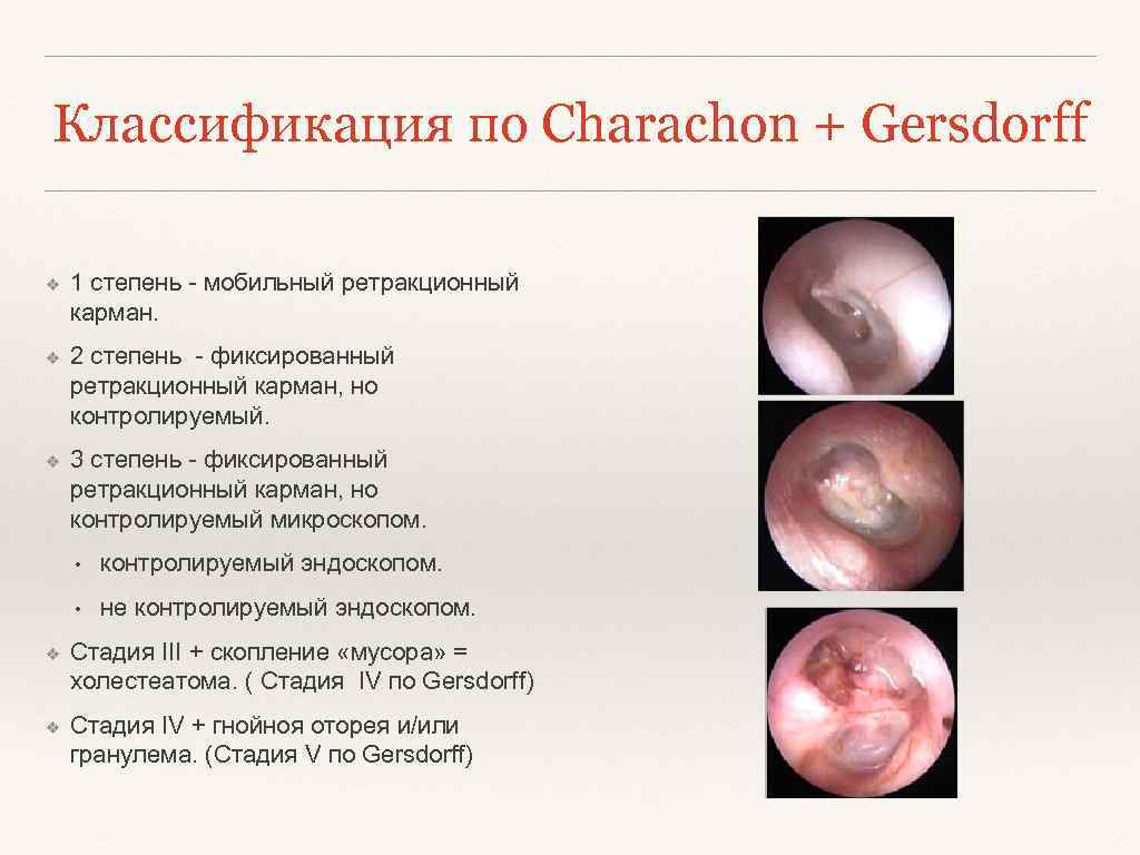 Классификация по Сharachon + Gersdorff ❖ 1 степень - мобильный ретракционный карман. ❖ 2