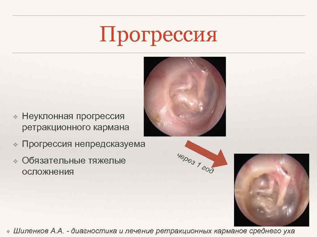 Прогрессия ❖ Неуклонная прогрессия ретракционного кармана ❖ Прогрессия непредсказуема ❖ ❖ Обязательные тяжелые осложнения