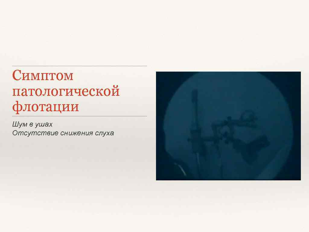 Симптом патологической флотации Шум в ушах Отсутствие снижения слуха 
