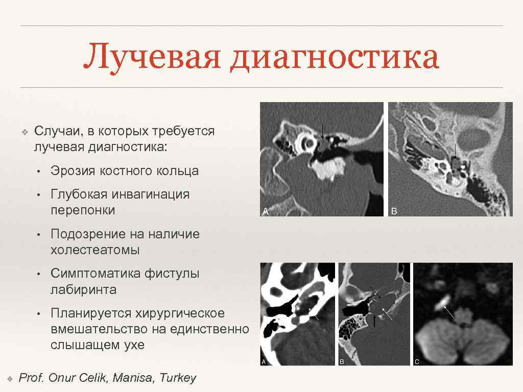 Лучевая диагностика ❖ Случаи, в которых требуется лучевая диагностика: • • Глубокая инвагинация перепонки