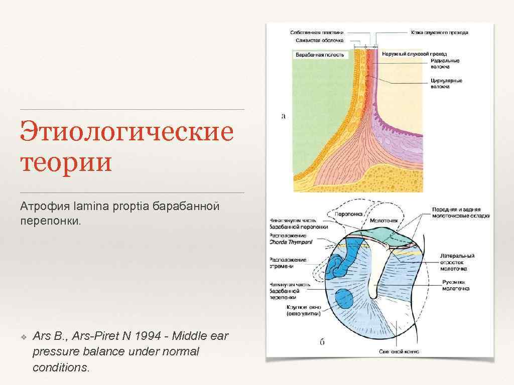 Этиологические теории Атрофия lamina proptia барабанной перепонки. ❖ Ars B. , Ars-Piret N 1994