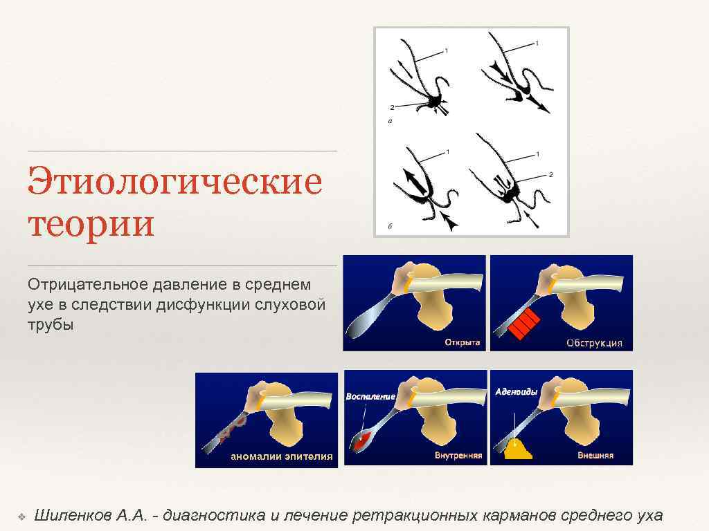 Этиологические теории Отрицательное давление в среднем ухе в следствии дисфункции слуховой трубы аномалии эпителия