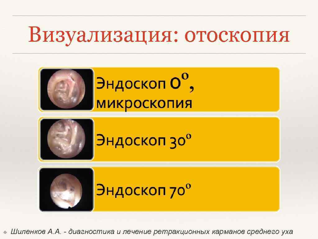 Визуализация: отоскопия ❖ Шиленков А. А. - диагностика и лечение ретракционных карманов среднего уха