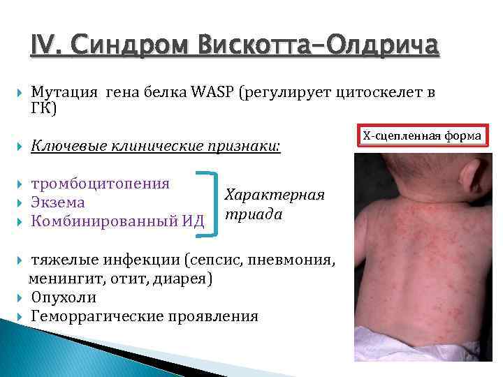 IV. Синдром Вискотта-Олдрича Мутация гена белка WASP (регулирует цитоскелет в ГК) Ключевые клинические признаки: