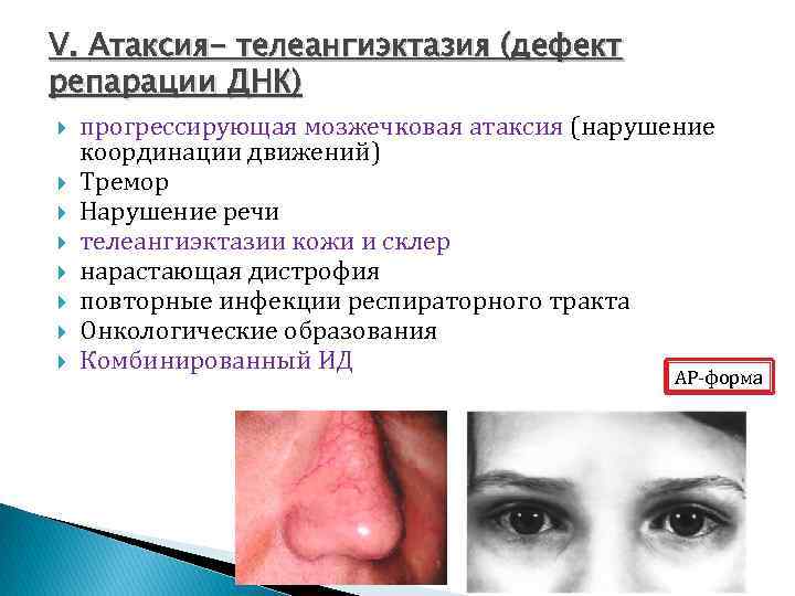 V. Атаксия- телеангиэктазия (дефект репарации ДНК) прогрессирующая мозжечковая атаксия (нарушение координации движений) Тремор Нарушение