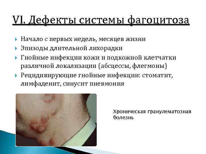 VI. Дефекты системы фагоцитоза Начало с первых недель, месяцев жизни Эпизоды длительной лихорадки Гнойные