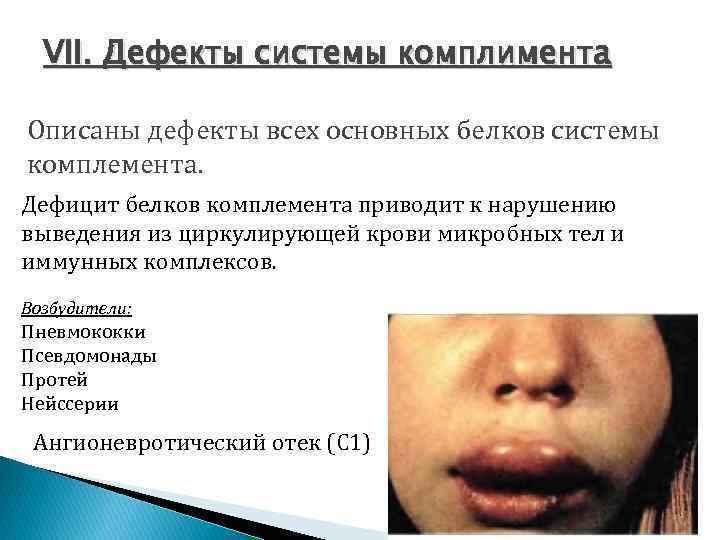 VII. Дефекты системы комплимента Описаны дефекты всех основных белков системы комплемента. Дефицит белков комплемента