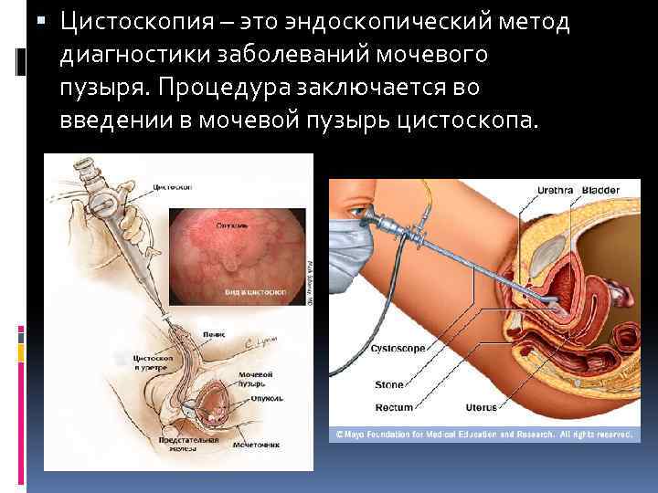  Цистоскопия – это эндоскопический метод диагностики заболеваний мочевого пузыря. Процедура заключается во введении