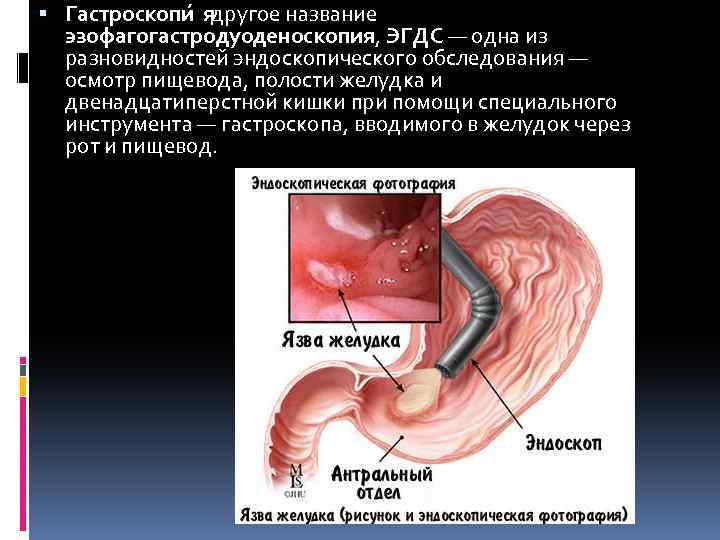  Гастроскопи я другое название эзофагогастродуоденоскопия, ЭГДС — одна из разновидностей эндоскопического обследования —