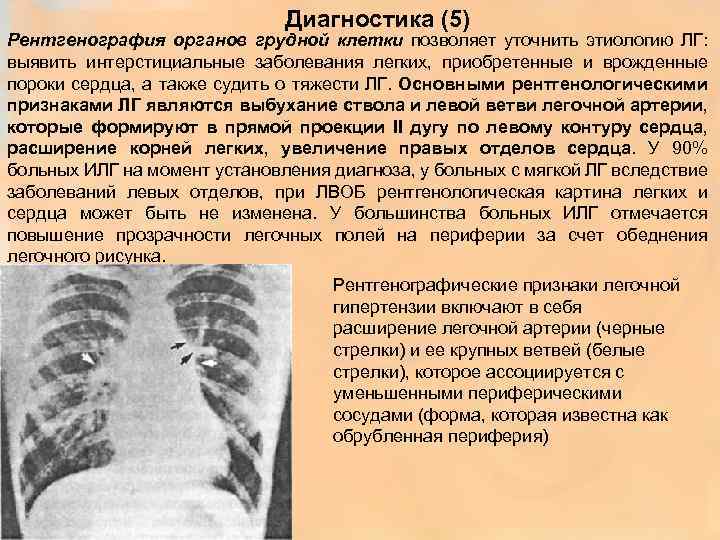 Диагностика (5) Рентгенография органов грудной клетки позволяет уточнить этиологию ЛГ: выявить интерстициальные заболевания легких,