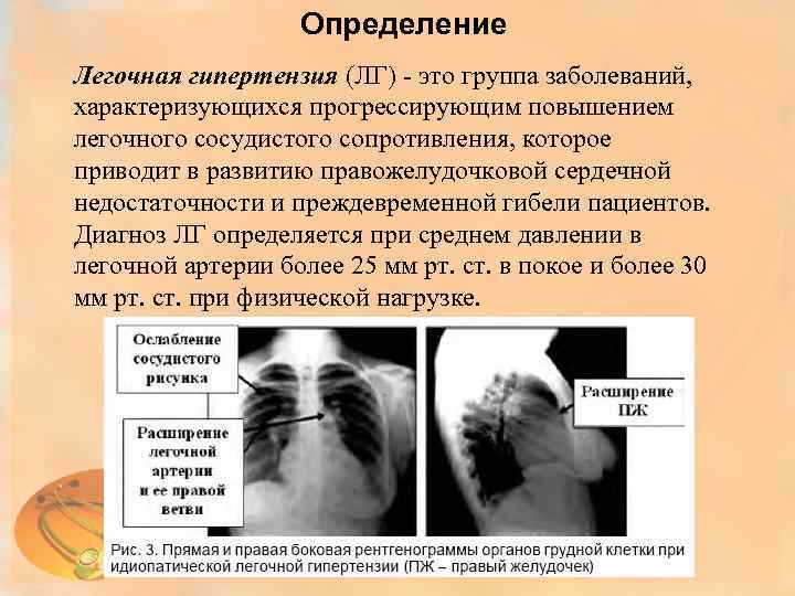 Определение Легочная гипертензия (ЛГ) - это группа заболеваний, характеризующихся прогрессирующим повышением легочного сосудистого сопротивления,