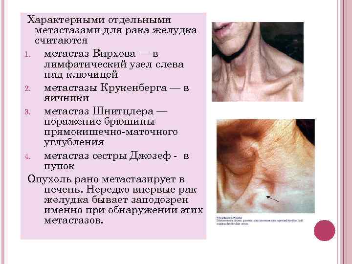 Характерными отдельными метастазами для рака желудка считаются 1. метастаз Вирхова — в лимфатический узел
