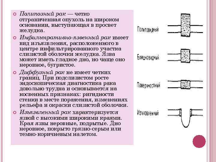  Полипозный рак — четко отграниченная опухоль на широком основании, выступающая в просвет желудка.