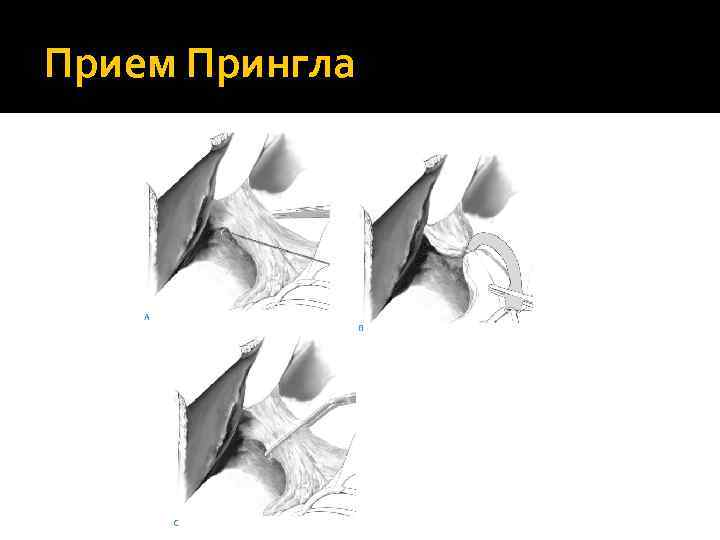 Прием Прингла 