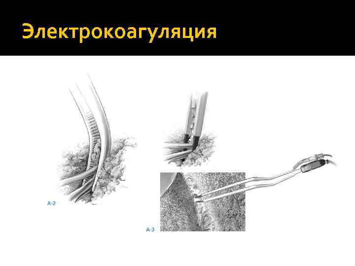 Электрокоагуляция 