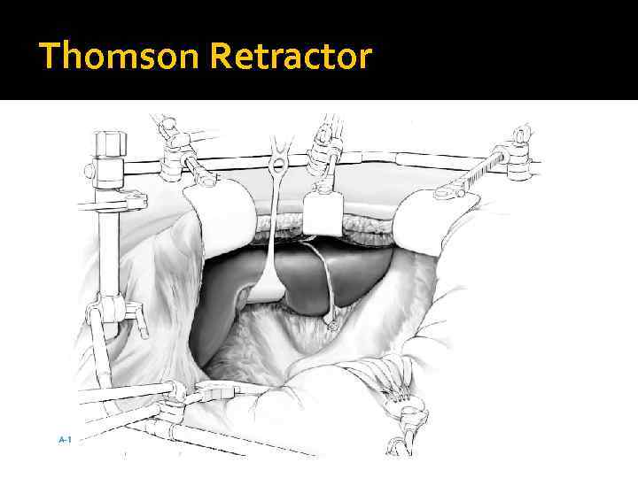 Thomson Retractor 