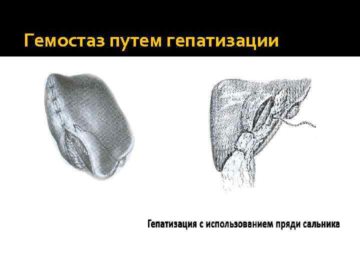 Гемостаз путем гепатизации 