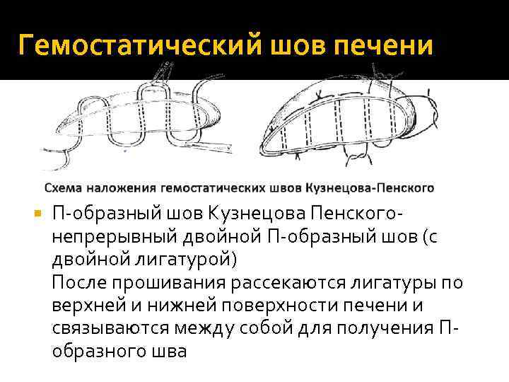 Гемостатический шов печени П-образный шов Кузнецова Пенского- непрерывный двойной П-образный шов (с двойной лигатурой)