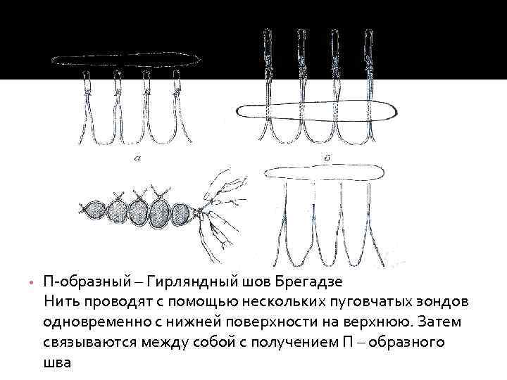  • П-образный – Гирляндный шов Брегадзе Нить проводят с помощью нескольких пуговчатых зондов