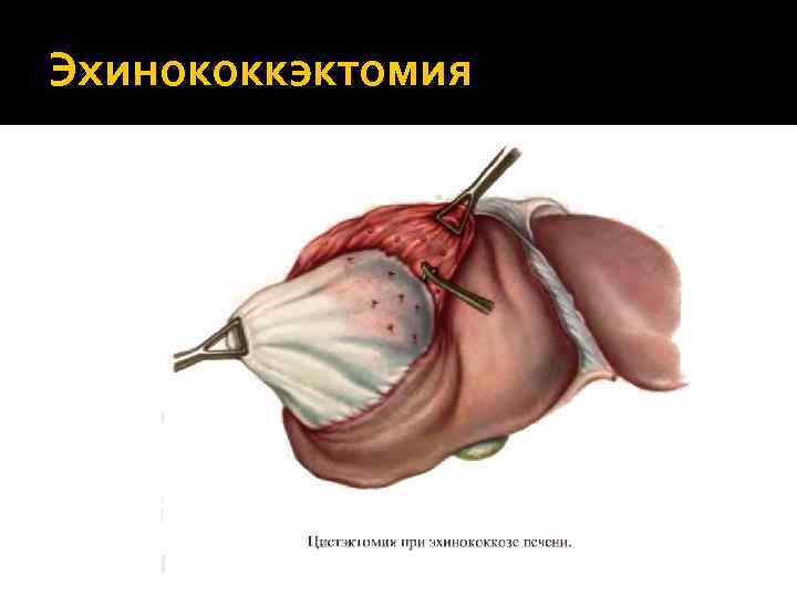 Эхинококкэктомия 