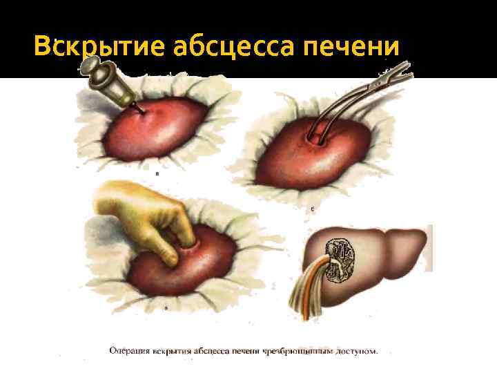 Вскрытие абсцесса печени 
