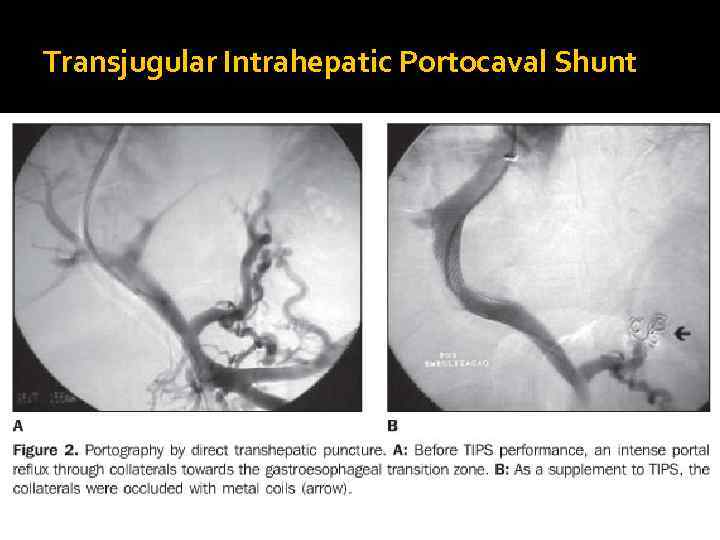 Transjugular Intrahepatic Portocaval Shunt 