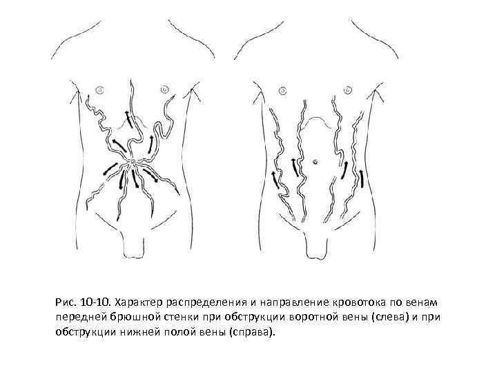 Рис. 10 10. Характер распределения и направление кровотока по венам передней брюшной стенки при