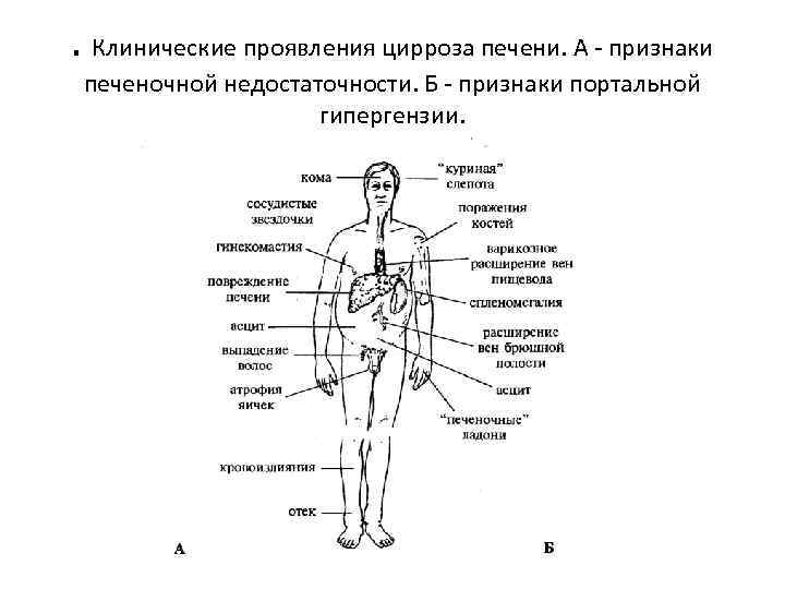 Клинические проявления цирроза печени. Основные клинические проявления цирроза печени. Схема основных проявлений цирроза печени. Клинические симптомы цирроза печени.