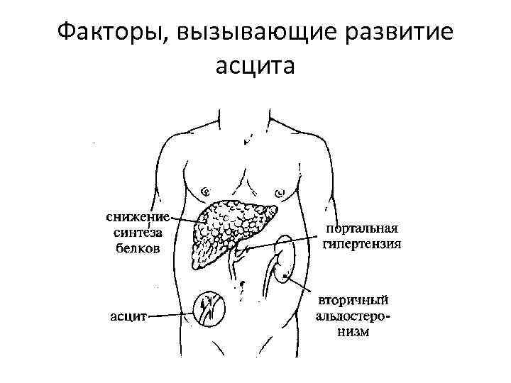 Факторы, вызывающие развитие асцита 