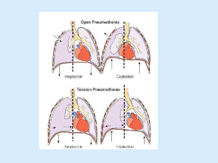 Пневмоторакс лечение. Патогенез клапанного пневмоторакса. Пневмоторакс физиология. Двухсторонний пневмоторакс. Наружный и внутренний клапанный пневмоторакс.