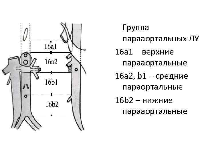 Группа парааортальных ЛУ 16 а 1 – верхние парааортальные 16 а 2, b 1