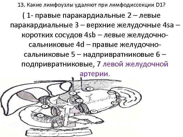 13. Какие лимфоузлы удаляют при лимфодиссекции D 1? ( 1 - правые паракардиальные 2