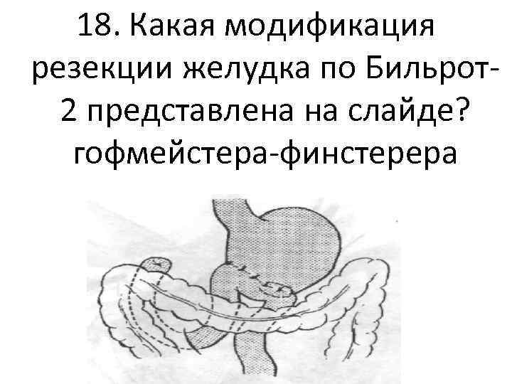 18. Какая модификация резекции желудка по Бильрот2 представлена на слайде? гофмейстера-финстерера 