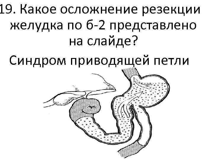 19. Какое осложнение резекции желудка по б-2 представлено на слайде? Синдром приводящей петли 