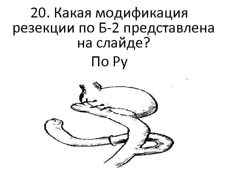 20. Какая модификация резекции по Б-2 представлена на слайде? По Ру 