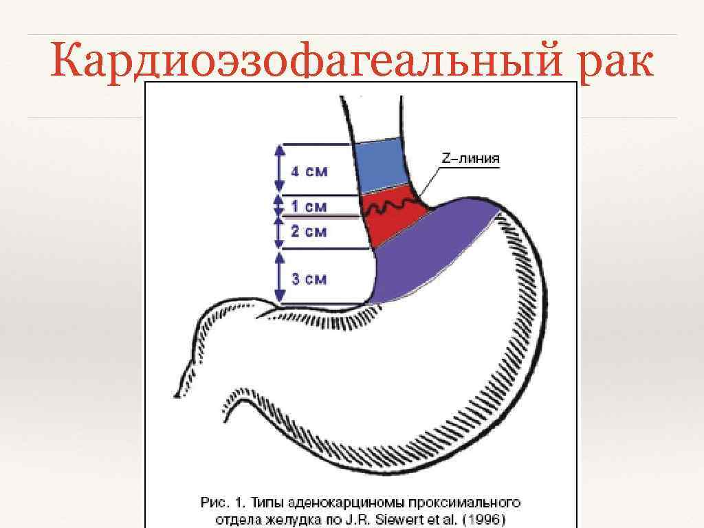 Z линия пищевода. Рентген кардиального отдела желудка. Кардиоэзофагинальныйрак. Кардиоэзофагеальный отдел желудка. Классификация отделов желудка.