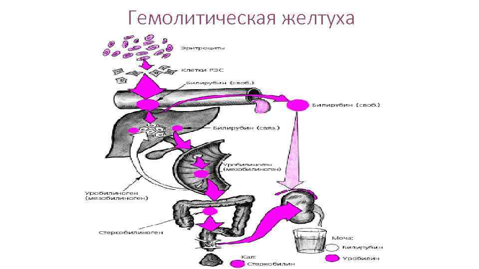 Гемолитическая желтуха 