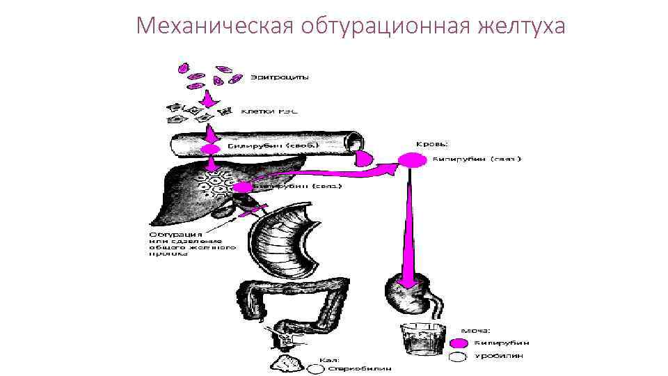 Механическая обтурационная желтуха 