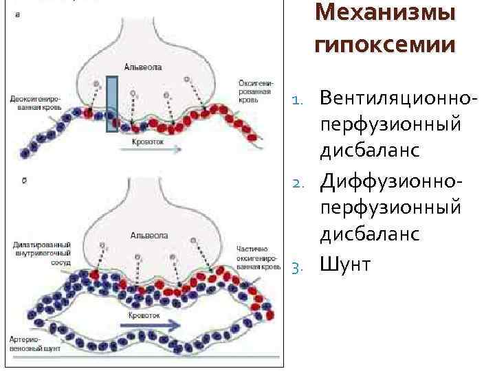 Механизмы гипоксемии Вентиляционноперфузионный дисбаланс 2. Диффузионноперфузионный дисбаланс 3. Шунт 1. 