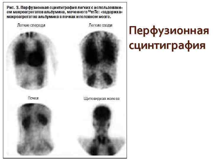 Перфузионная сцинтиграфия 