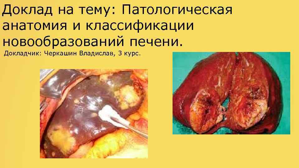 Доклад на тему: Патологическая анатомия и классификации новообразований печени. Докладчик: Черкашин Владислав, 3 курс.