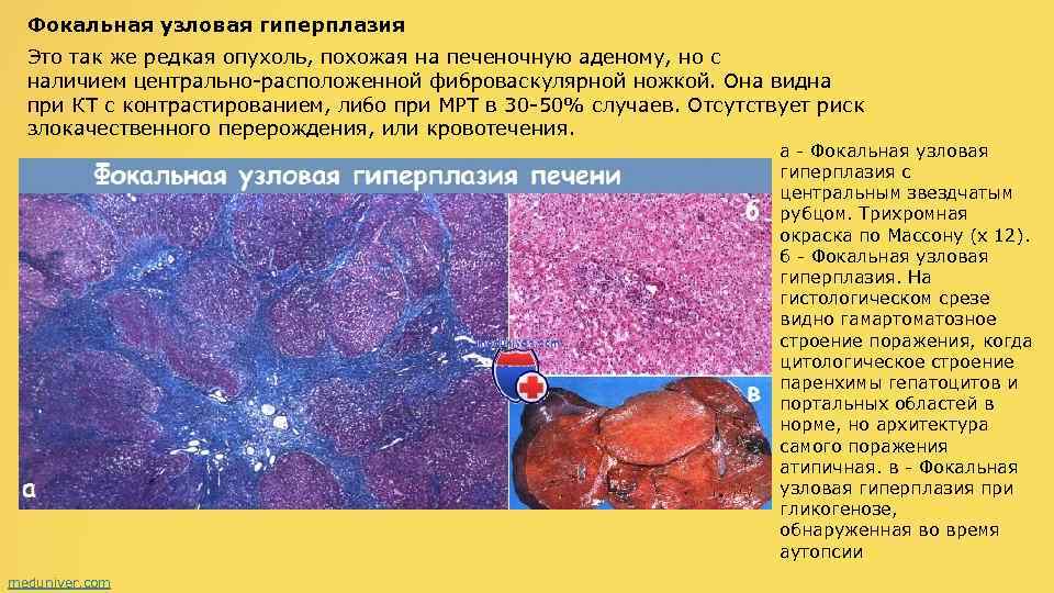 Фовеолярная гиперплазия желудка на фоне хронического гастрита