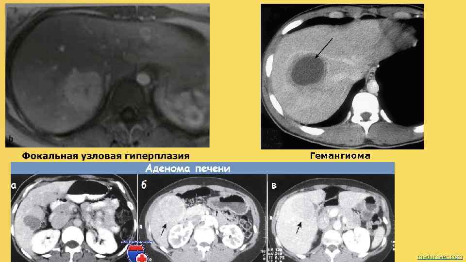 Гемангиома meduniver. com 