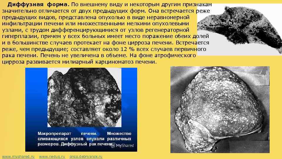 Диффузная форма. По внешнему виду и некоторым другим признакам значительно отличается от двух предыдущих