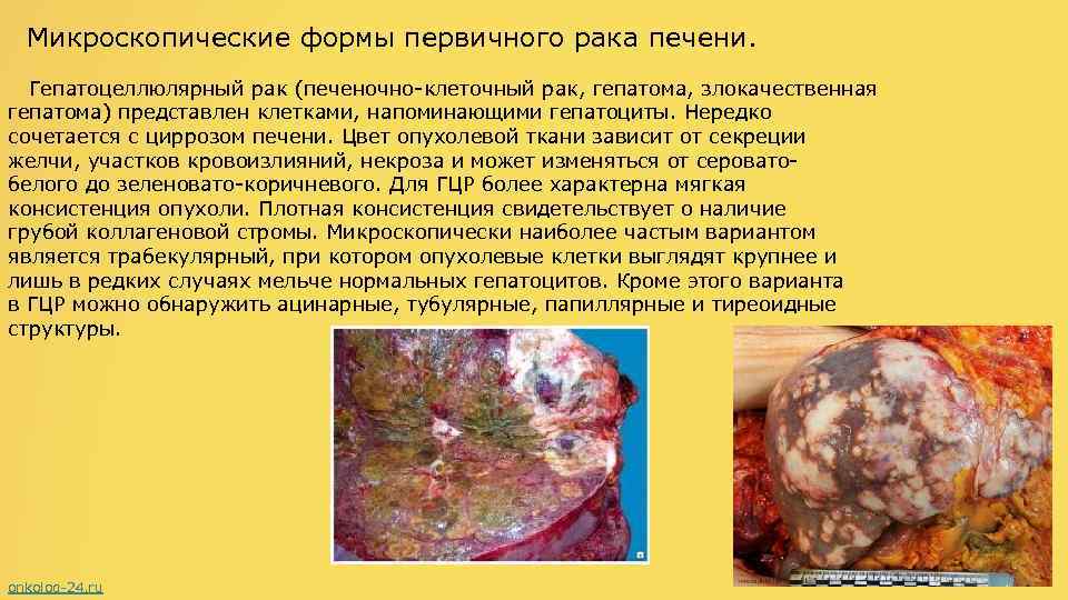 Микроскопические формы первичного рака печени. Гепатоцеллюлярный рак (печеночно-клеточный рак, гепатома, злокачественная гепатома) представлен клетками,
