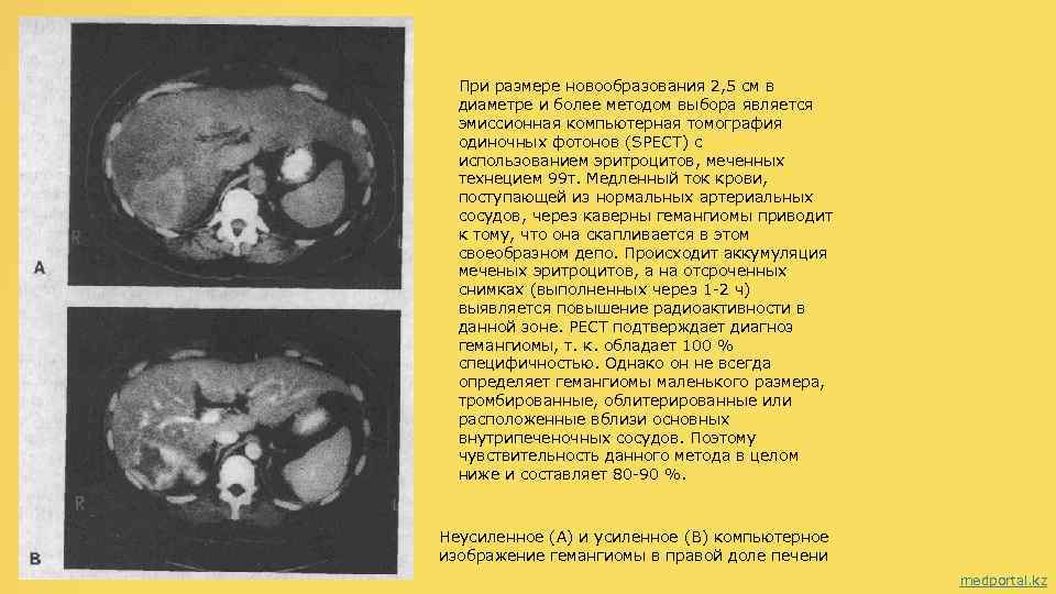 При размере новообразования 2, 5 см в диаметре и более методом выбора является эмиссионная