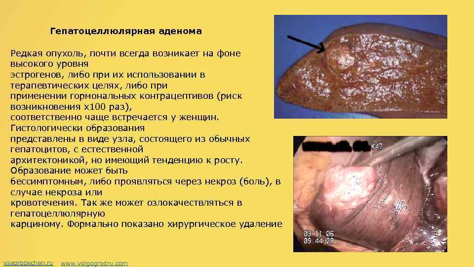 Гепатоцеллюлярная аденома Редкая опухоль, почти всегда возникает на фоне высокого уровня эстрогенов, либо при