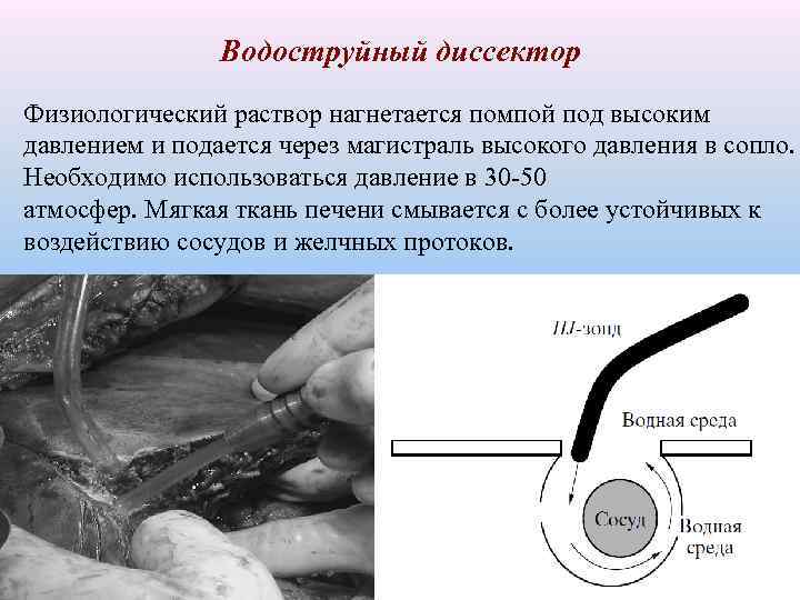 Водоструйный диссектор Физиологический раствор нагнетается помпой под высоким давлением и подается через магистраль высокого