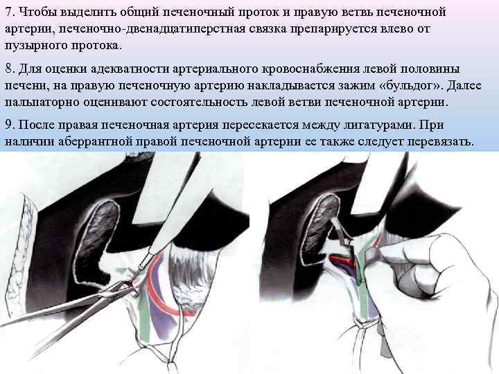 7. Чтобы выделить общий печеночный проток и правую ветвь печеночной артерии, печеночно-двенадцатиперстная связка препарируется