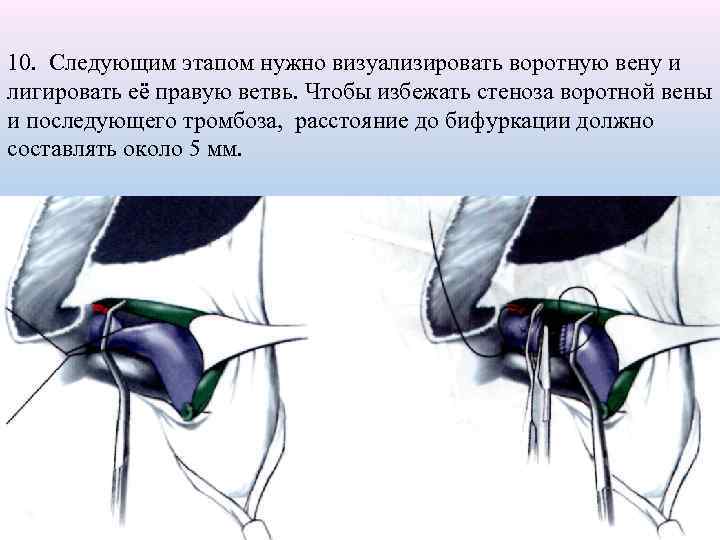 10. Следующим этапом нужно визуализировать воротную вену и лигировать её правую ветвь. Чтобы избежать